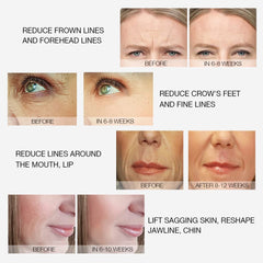 MLAY Professional RF Beauty Machine for Lifting, Toning, Wrinkle Removal, Facial and Body Skin Tightening